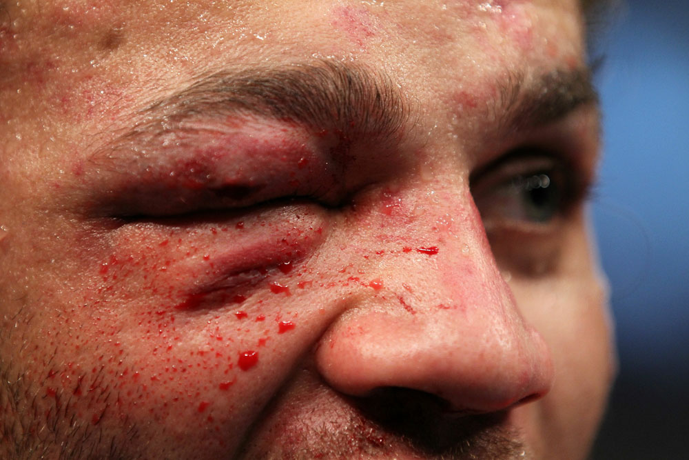 UFC 124: Josh Koscheck's Right eye