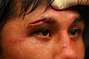 LAS VEGAS, NV - DECEMBER 30:  Nam Phan has a cut inspected after his fight with Jimy Hettes during the UFC 141 event at the MGM Grand Garden Arena on December 30, 2011 in Las Vegas, Nevada.  (Photo by Donald Miralle/Zuffa LLC/Zuffa LLC via Getty Images) *** Local Caption *** Nam Phan