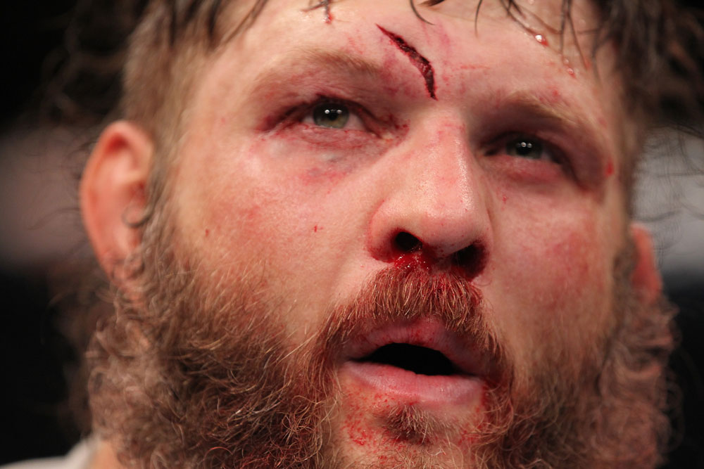 LAS VEGAS, NV - FEBRUARY 04:  Roy Nelson displays his cut from his fight with Fabricio Werdum during the UFC 143 event at Mandalay Bay Events Center on February 4, 2012 in Las Vegas, Nevada.  (Photo by Nick Laham/Zuffa LLC/Zuffa LLC via Getty Images) *** Local Caption *** Roy Nelson