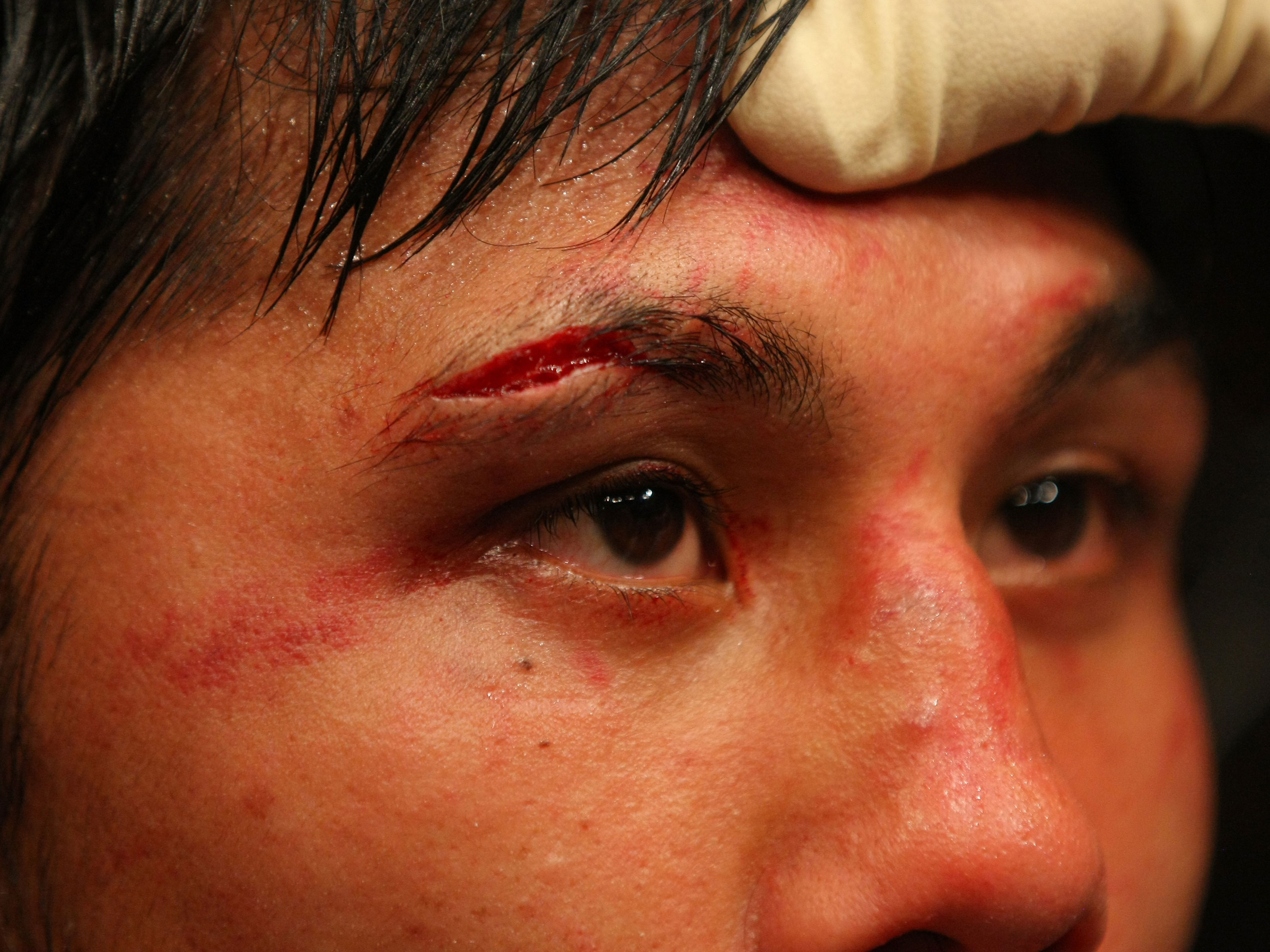 LAS VEGAS, NV - DECEMBER 30: Nam Phan has a cut inspected after his fight with Jimy Hettes during the UFC 141 event at the MGM Grand Garden Arena on December 30, 2011 in Las Vegas, Nevada. (Photo by Donald Miralle/Zuffa LLC/Zuffa LLC via Getty Images) *** Local Caption *** Nam Phan